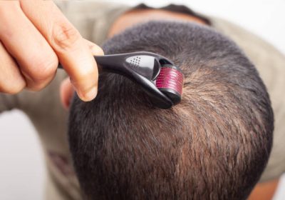 A young man using dermaroller to tackle hair loss and to promote hair growth on scalp.